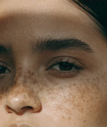 Rosto de uma paciente antes do protocolo de acne